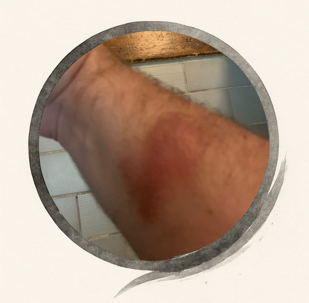 Gi and Bruises – The Beginner’s Badges of Honor